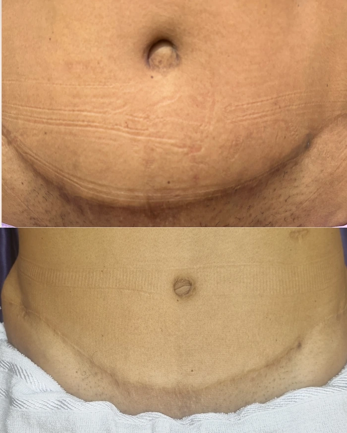 Antes e depois da camuflagem de cicatriz na região abdominal