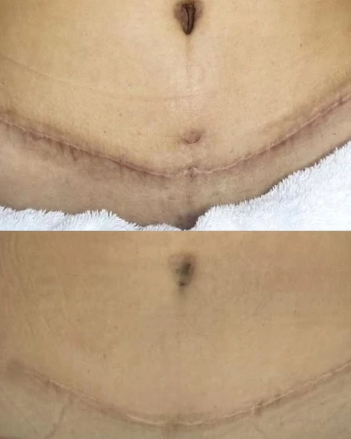 Antes e depois da camuflagem de cicatriz de cesárea