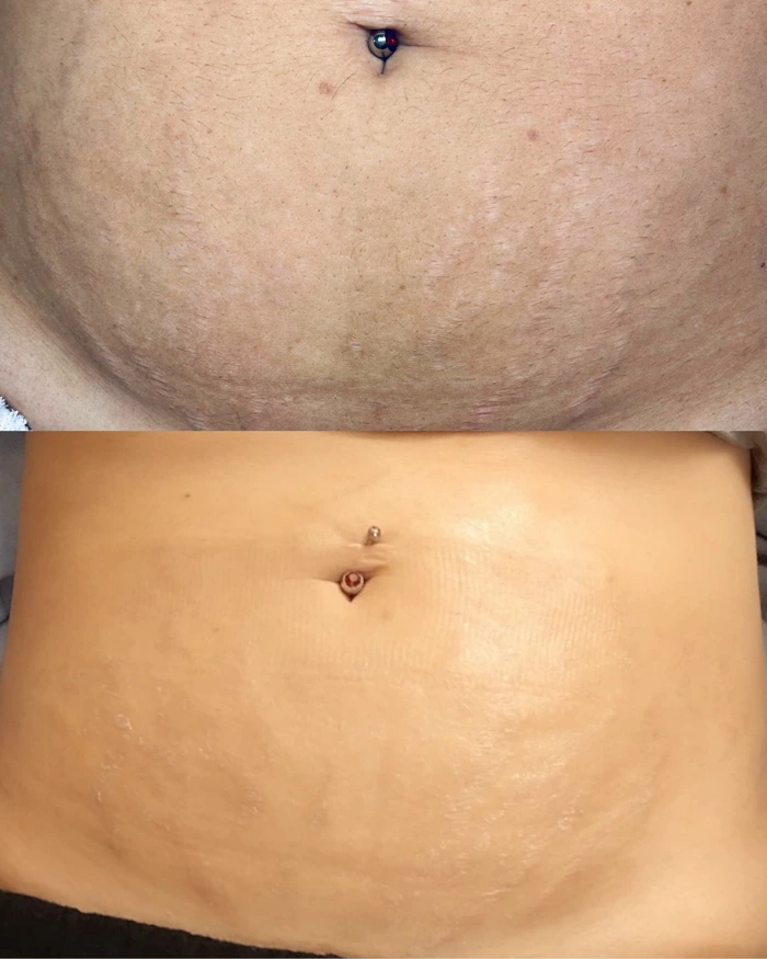 Antes e depois do tratamento de estrias na barriga - dermopigmentação paramédica
