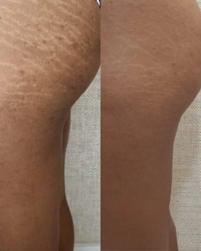 Antes e depois do tratamento de estrias na perna e glúteo