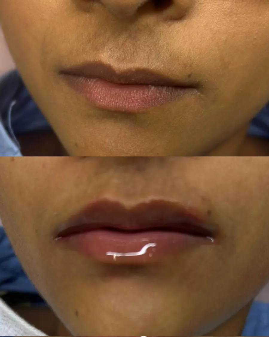 Antes e depois do tratamento Hydra Color para realce da tonalidade dos lábios