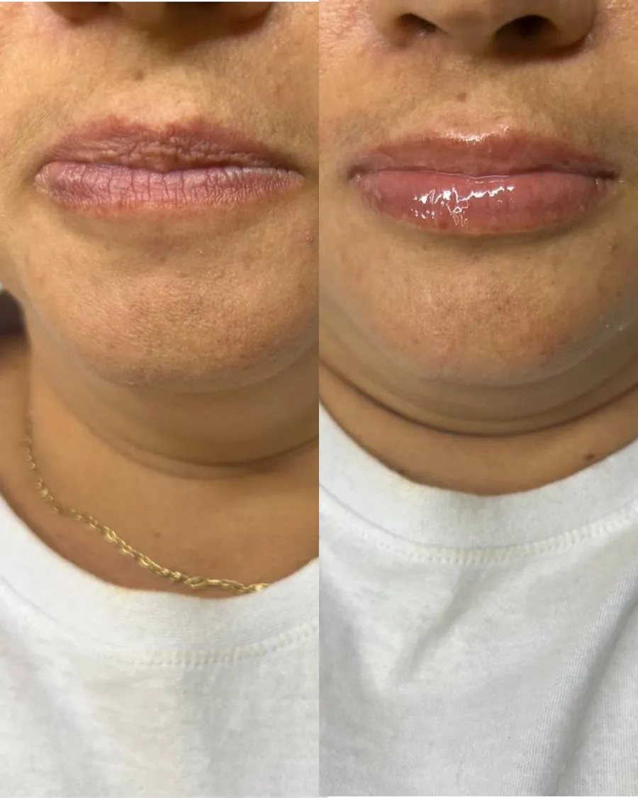 Antes e depois do tratamento Hydra Lips para hidratação labial