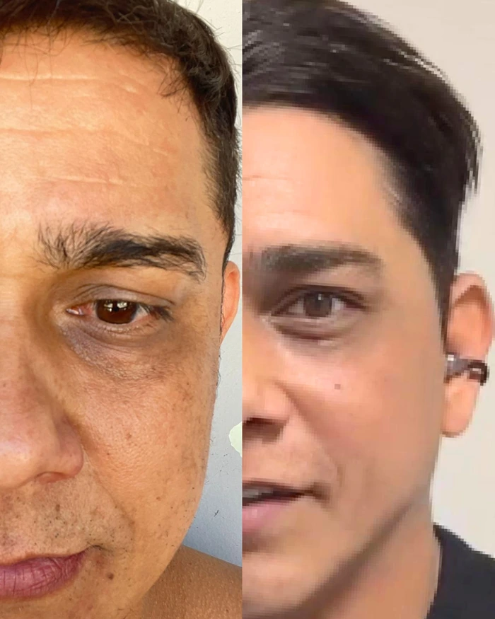 Antes e depois da neutralização de olheiras
