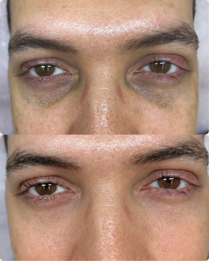 Antes e depois da neutralização de olheiras profundas