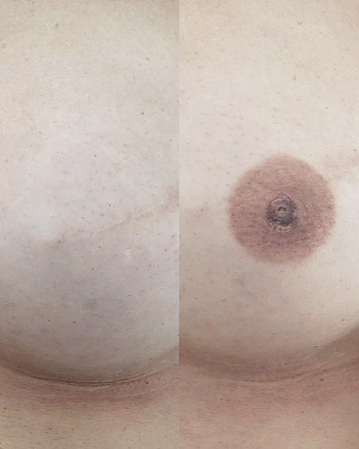 Antes e depois da reconstrução de auréola